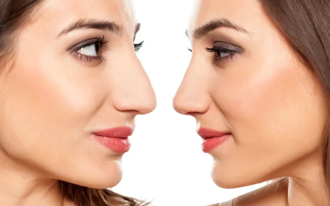 All About Nose Job Correct Nose Flaws Without Surgery Non Surgical