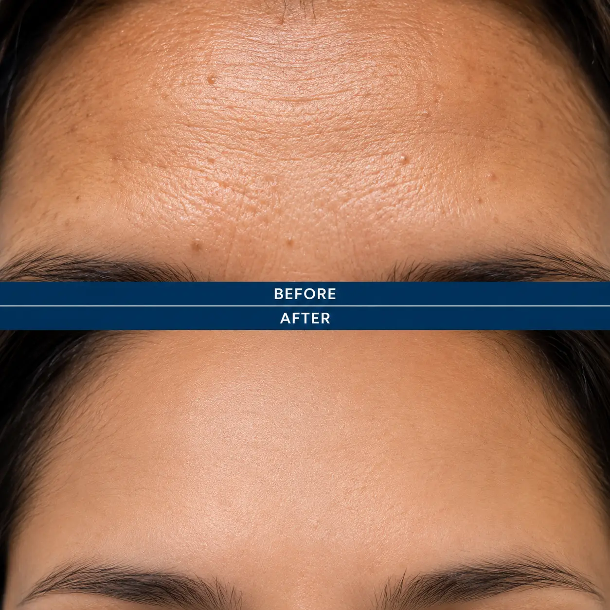 Botox filler Treatment Buckingham