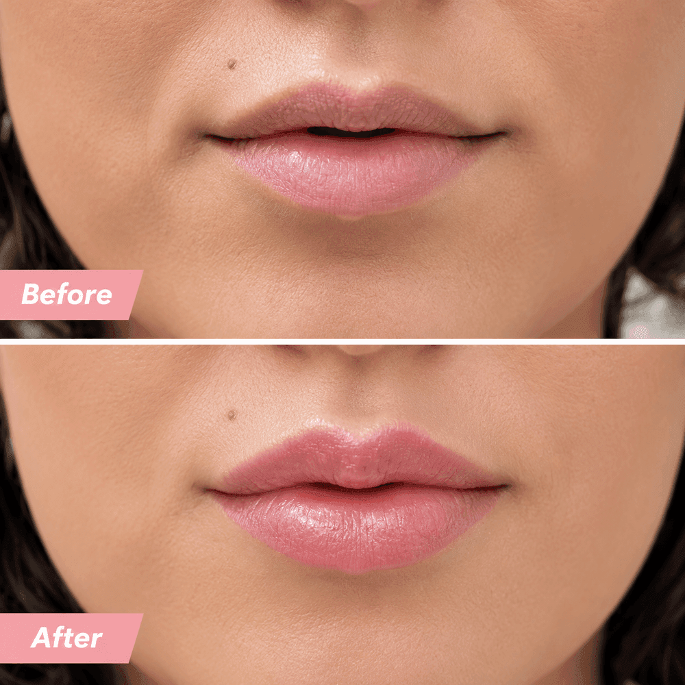 Lip filler Treatment in Milton Keynes