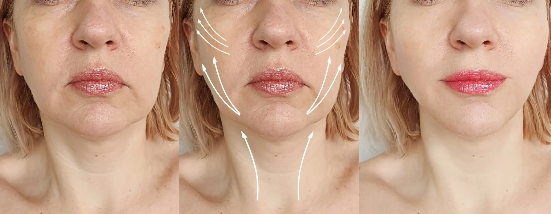 Face lifting image