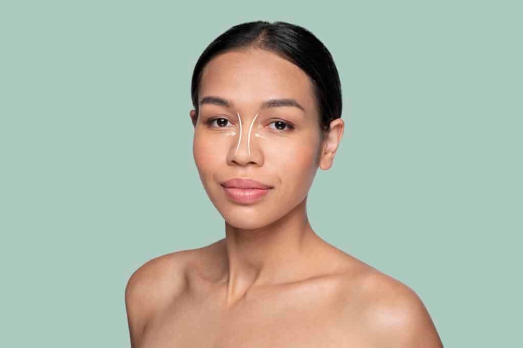 Non-surgical rhinoplasty with dermal fillers for smoother nose profile