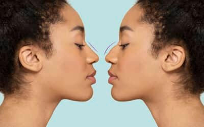 Everything You Need to Know About Non-Surgical Rhinoplasty in Milton Keynes 