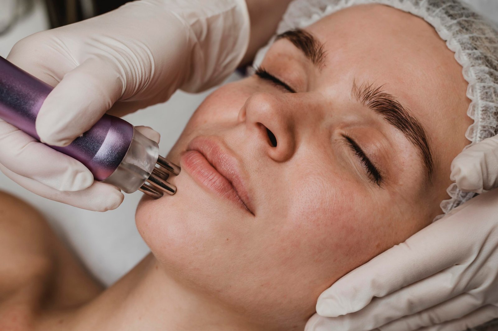 SkinPen Microneedling treatment in Milton Keynes for acne scars, uneven texture, and skin rejuvenation