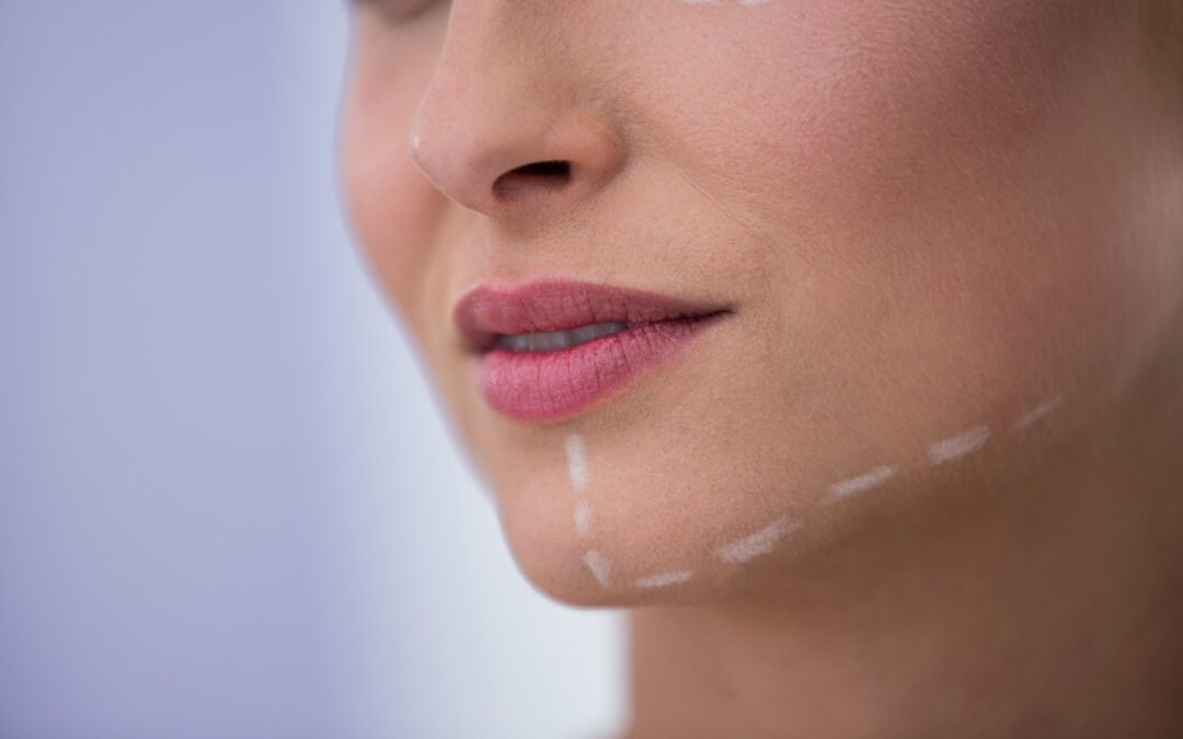 Cheek augmentation in Milton Keynes before and after