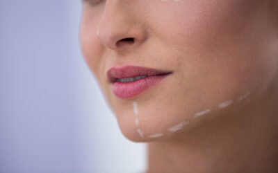 What Is a Cheek Augmentation? Everything You Need to Know