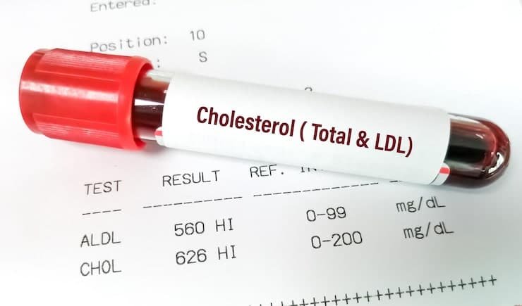 Cholesterol test in the UK showing lipid profile blood analysis