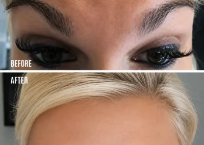 Botox Treatment in milton keynes, buckinghamshire