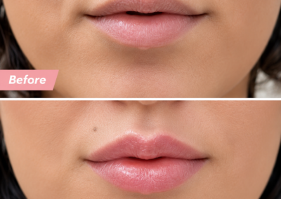 Lip filler Treatment in Milton Keynes