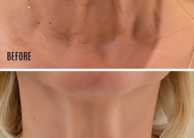 Neck Tightening Treatment, buckinghamshire