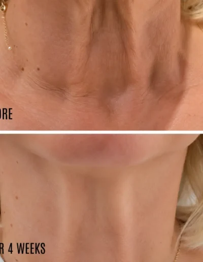 Neck Tightening Treatment, buckinghamshire